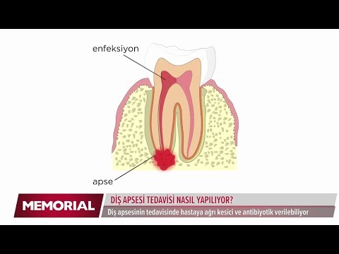 Diş apsesi nedir ve nedenleri nelerdir? - Dt. Aslı Tapan (Ağız ve Diş Sağlığı Uzmanı)