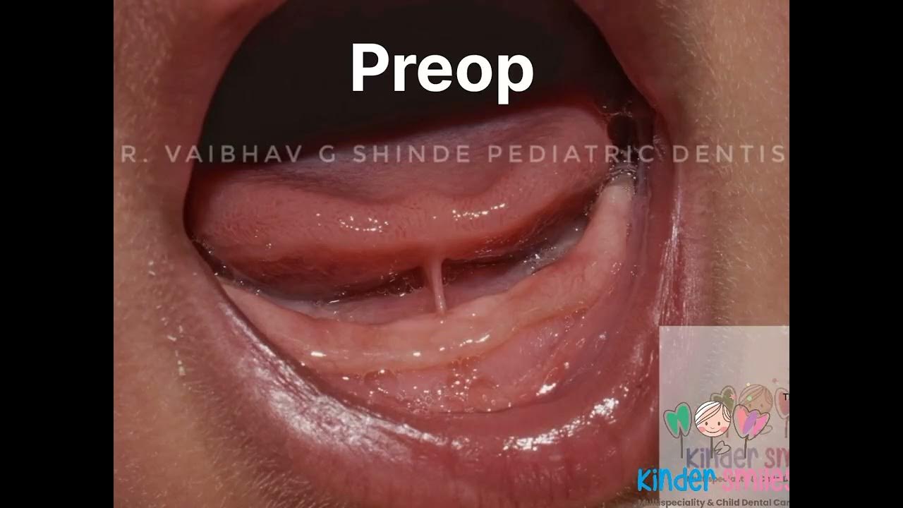 Tongue Tie Release Lingual Frenotomy Youtube 