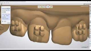 3Shape OrthoAnalyzer: Artifacts Remove