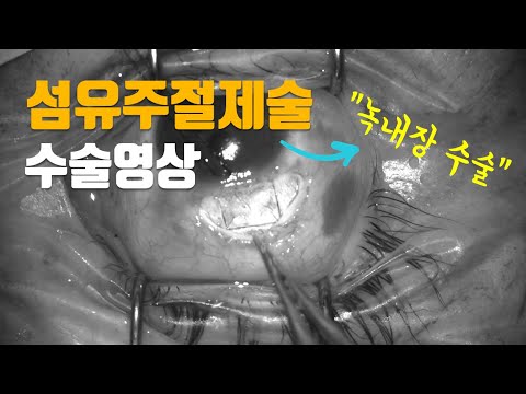 녹내장 수술 영상 - 섬유주절제술 수술 과정