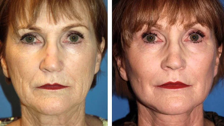 Cheek Implants in Seattle WA | Dr William Portuese