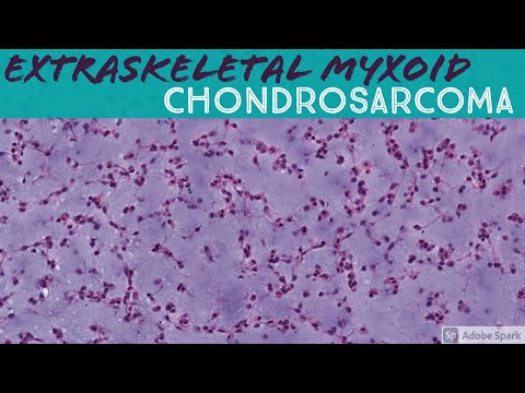 Video: Neuskanker (Chondrosarcoma) By Honde