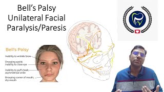Dr Rudra Mohan | Bell's Palsy- Unilateral Facial Paralysis/Paresis