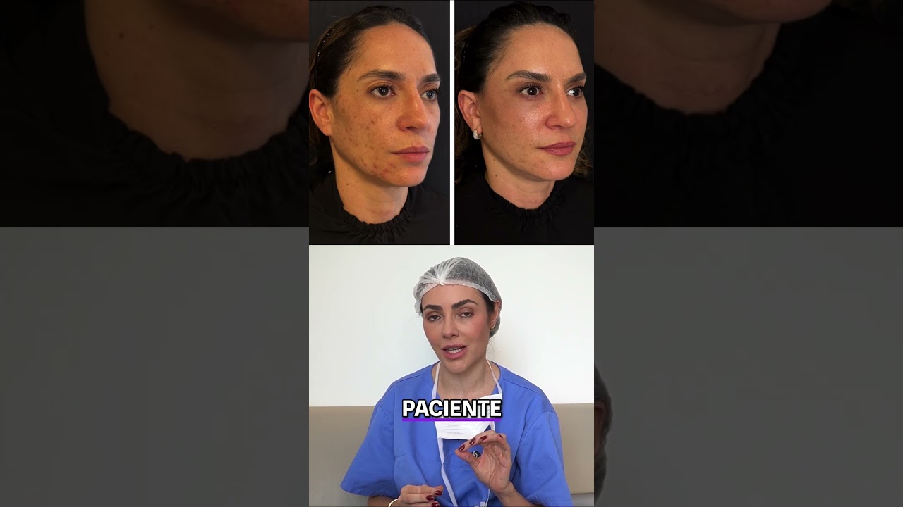 Facelift Completo, 35 Dias de Transformação Facial Incrível!
