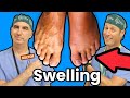 Foot and ankle swelling what causes it