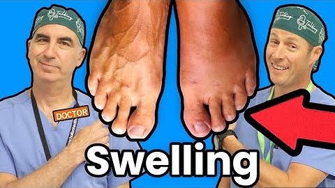 Pembengkakan Kaki dan Pergelangan Kaki: Apa Penyebabnya?