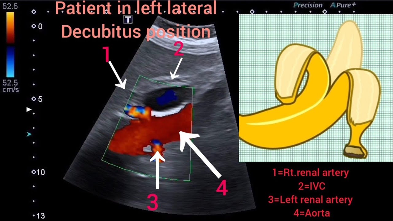 Banana Peel Sign Renal Arteries Doppler Renal Artery Stenosis Banana Peel Sign Renal Arteries Doppler Renal Artery Stenosis
