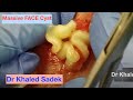 Massive face cyst lipomacystcom dr khaled sadek