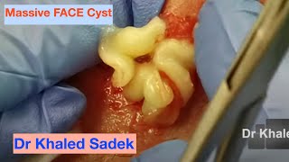 massive face cyst. LipomaCyst.com Dr Khaled Sadek