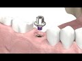 SIC invent  Dental Implant  - Prosthetic Animation: Single Crown (Closed Tray Technique)