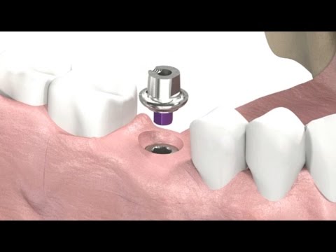 Video: Dental Crown Prosthetics