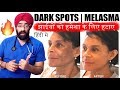 Permanently Cure DARK SPOTS, झाइयां, MELASMA, HYPERPIGMENTATION or BLACK MARKS (HINDI) Dr.Education