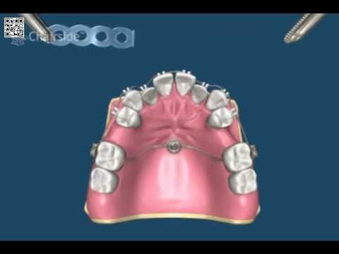Ортодонтия и имплантация