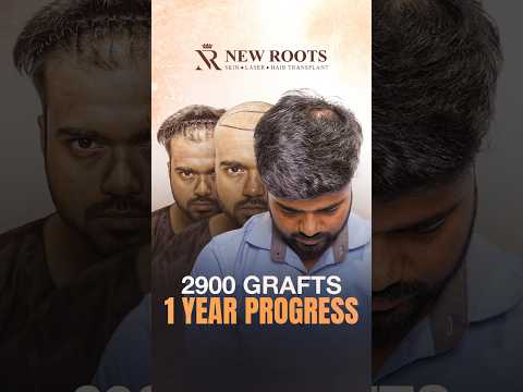 2900 Grafts Hair Transplant in Kolkata | Hair Transplant Cost and Results in Kolkata #shorts