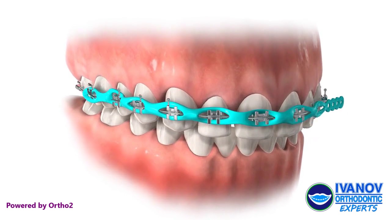 Braces Band Colors That Make Your Teeth Look Whiter