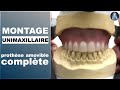 Unimaxillaire  montage des dents  prothse amovible complte  prothse dentaire  