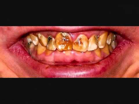 FLUORIDE : The Experts at NAS/NRC  5 / 20
