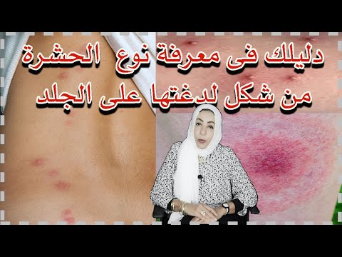 فيديو: هل تؤلم لدغة القراد؟