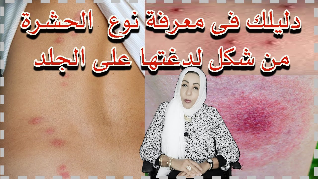 دليلك في معرفة نوع الحشرة من شكل لدغتها على الجلد #لدغ_الحشرات #قرص_الناموس #لاتنسى_الاشتراك_وعمل👍