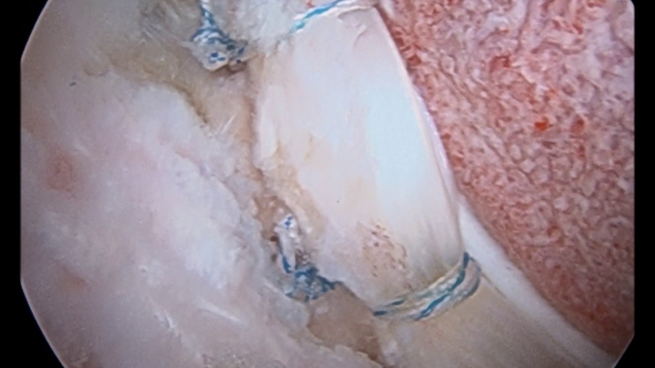 Dinamico tras extirpación de Cam camera iphone 8 plus apk