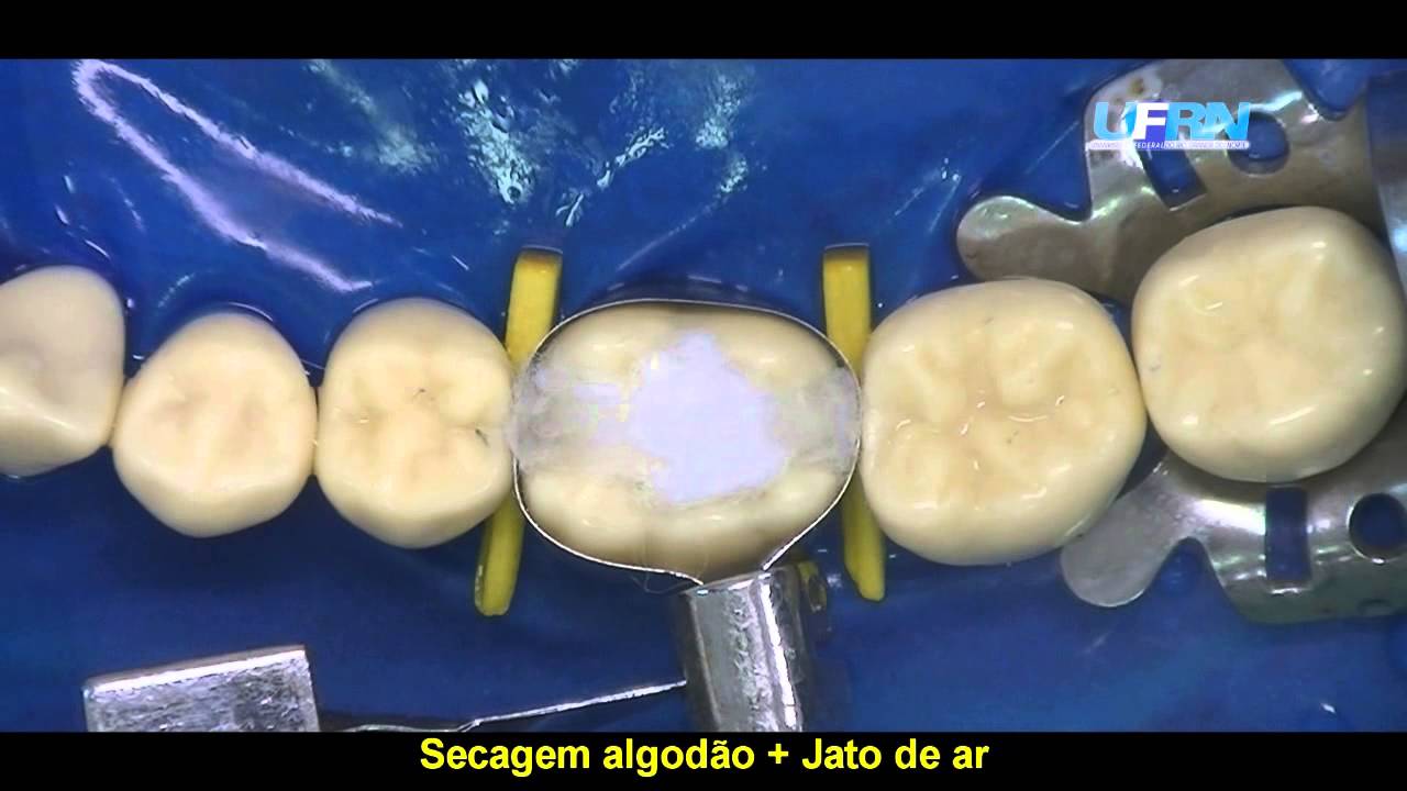 UFRN - RESTAURAÇÃO DE AMALGAMA CLASSE II  36 (MOD)