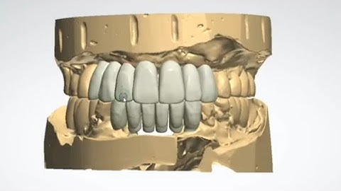 3shape design (anterior teeth 😬 osstem implant case)
