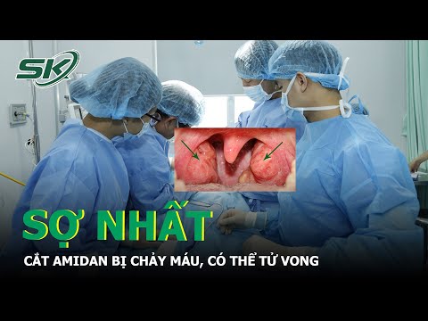 Video: Làm thế nào để điều trị viêm amidan: 11 bước (có hình ảnh)