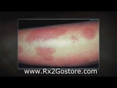 www.rx2gostore.com - Visit this online pharmacy to shop for Mometasone Furoate Cream and learn about its usage more in-depth ( plus It has great discount prices).