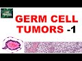 OVARIAN TUMORS -  Part 4: Germ cell tumors:  Dysgerminoma, yolk sac tumor - Pathology