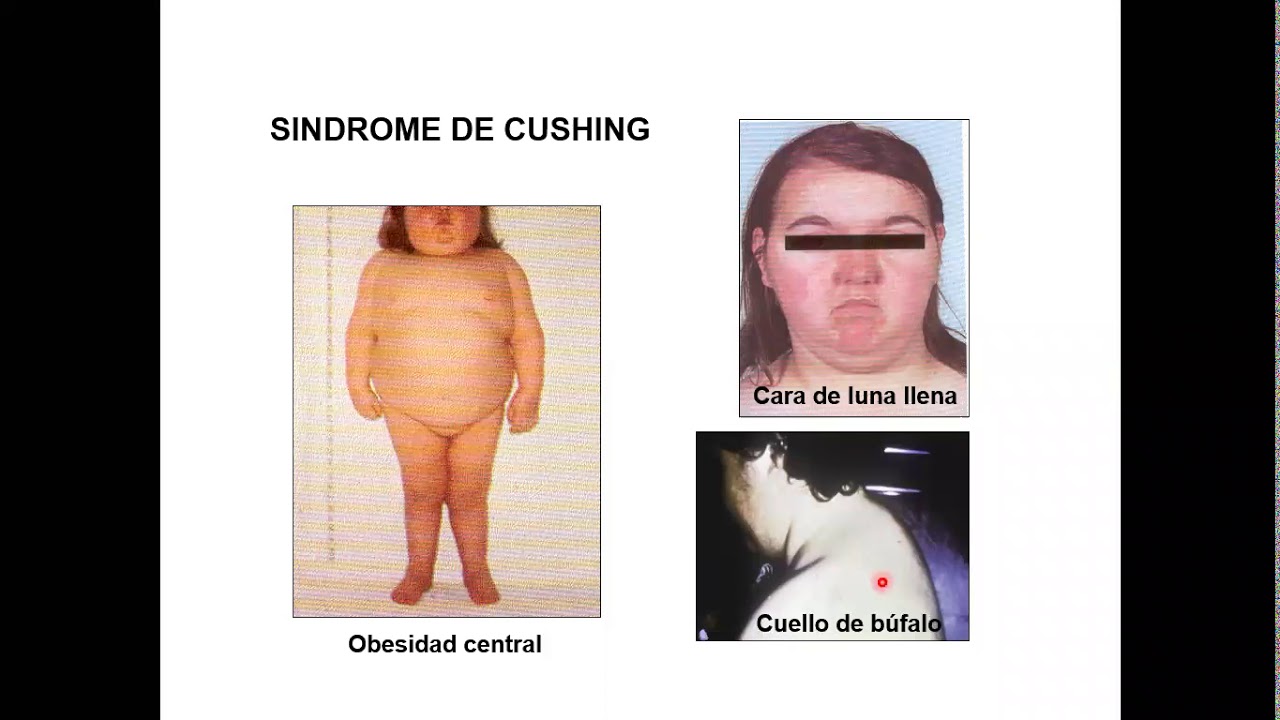 sindrome de cushing YouTube sindrome de cushing YouTube