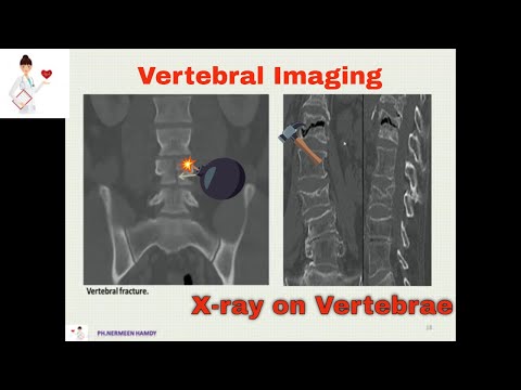 Borad-Osteoporosis 3 : Vertebral Imaging, FRAX Score and Other Screening Tools. Whom to be treated ?