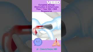 INFANT CHOKING - less than 1 year old + complete obstruction + responsive