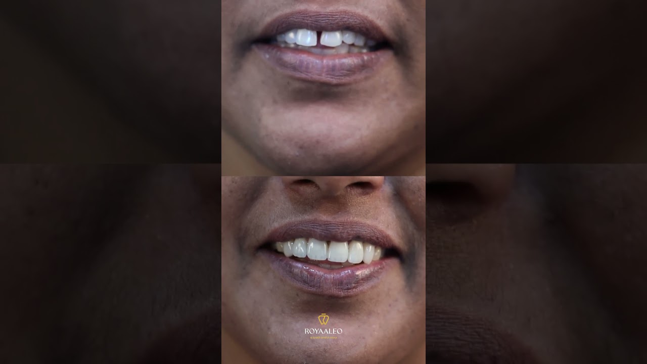 Smile Makeover | Best Dental Clinic in Malappuram, Kerala | Royaaleo Dental Clinic | 