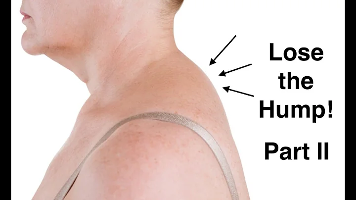 Neck Hump Exercises (With FREE Exercise Sheet!)