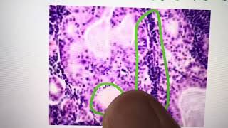 Warthin’s tumor histology step 1￼