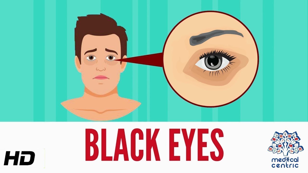 What Causes A Black Eye? - Potthoff Eye Care and Surgery