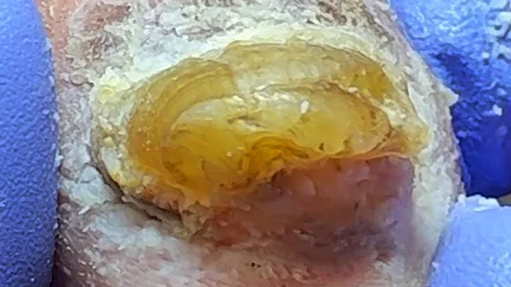 There Is Nothing Under The Nail, Poor Onychomycosis【Podiatry Clinic】