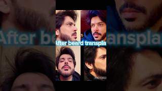 Beard Hair Restoration: Get a Thicker, Fuller Beard #videoviral #shortvideo