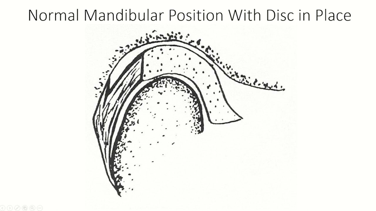 Displaced TMJ Disc Part 2 | Treatment of displaced TMJ discs | Dr. Wesley Shankland