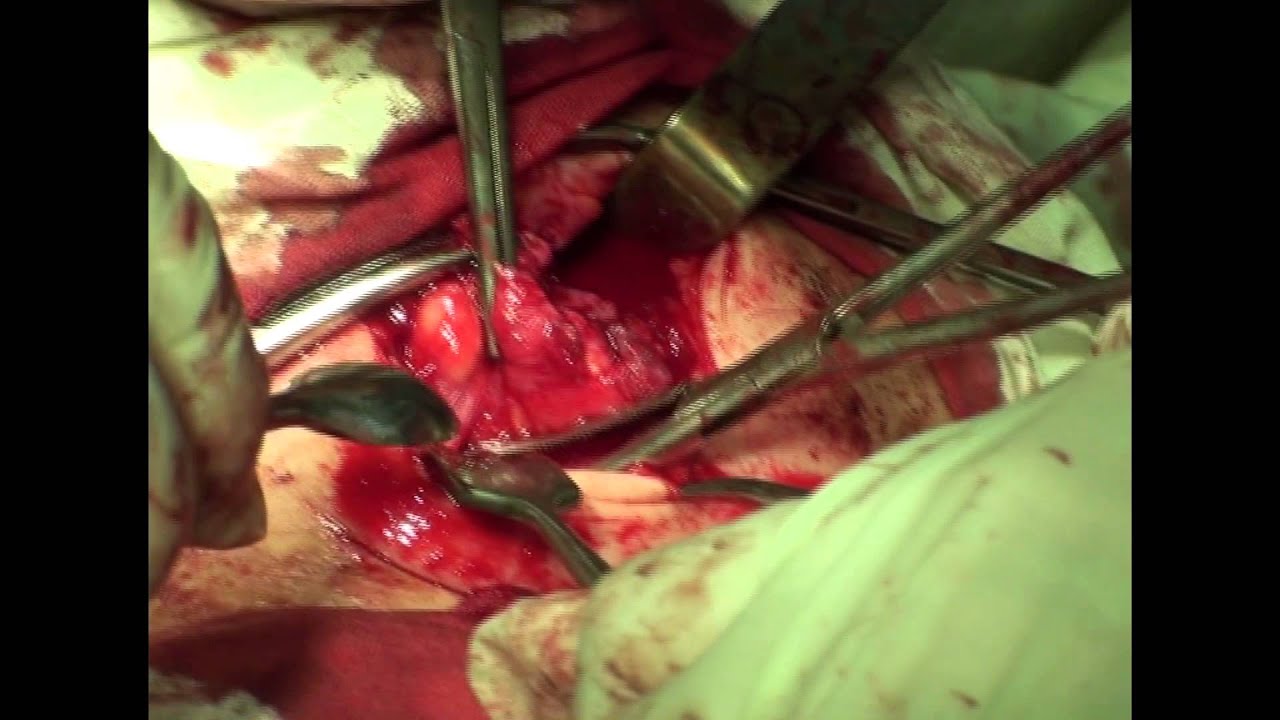 ОСТЕОБЛАСТОКЛАСТОМА