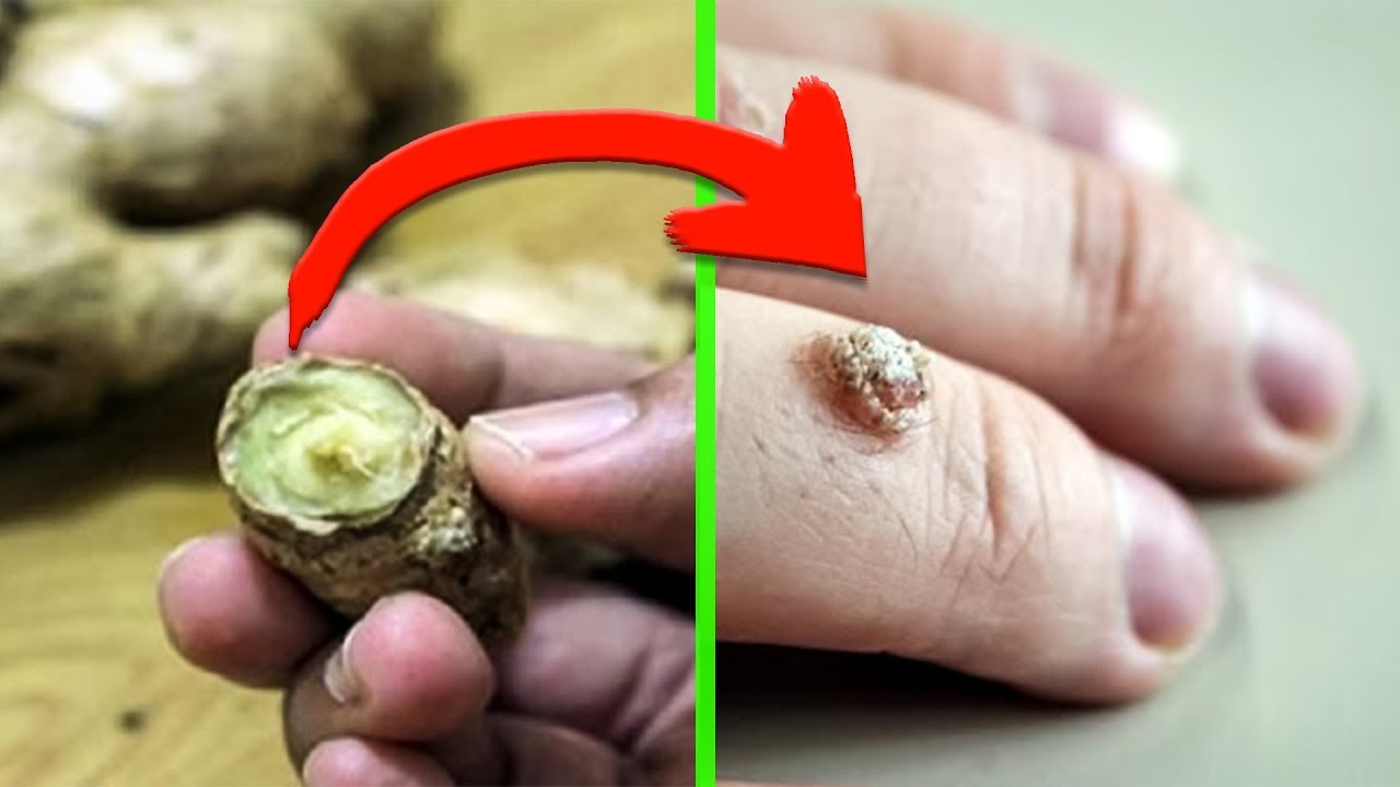 Избавиться от бородавок, папиллом и возрастных пятен. Помогут эти ...