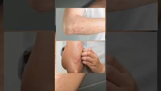 Download Lagu siapa yang kulitnya bersisik dan kering ? wajib pake ini MP3