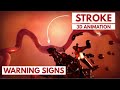 How to Recognize a Stroke? | 3D Animation