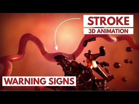 How to Recognize a Stroke? | 3D Animation