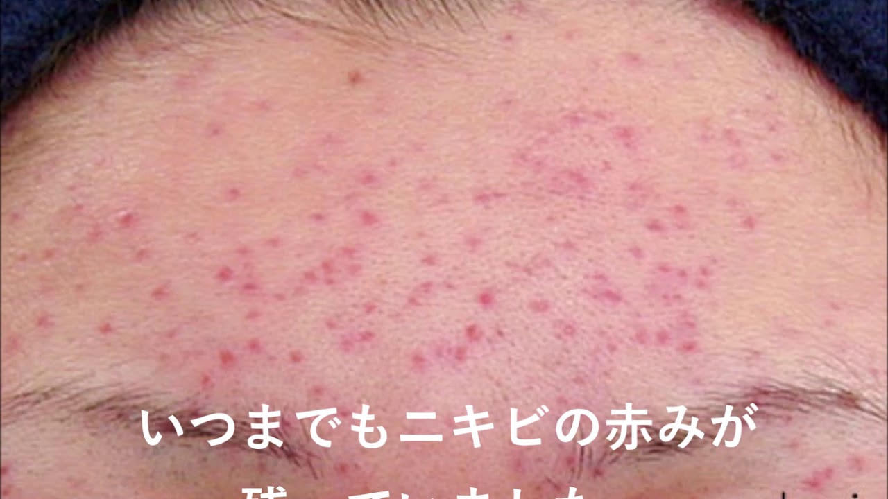 額 おでこ のニキビ跡の赤み はスキンケアで見事に解決 Youtube 額 おでこ のニキビ跡の赤み はスキンケアで見事に解決 Youtube