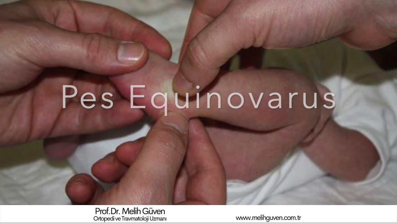 Doğuştan Çarpık Ayak Deformitesi pes equinovarus ya da yumru
