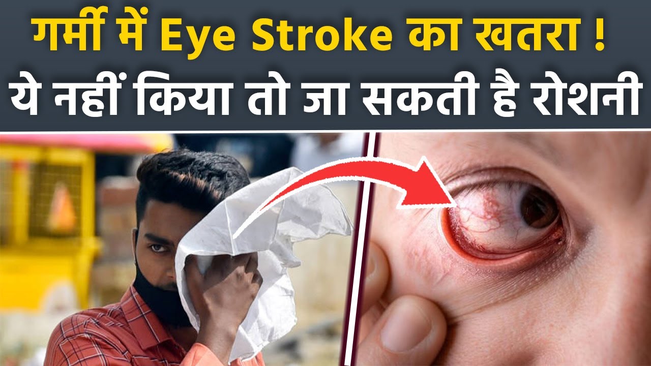Eye Stroke Kya Hai Eye Stoke Kese Hota Hai Eye Stroke Symptoms