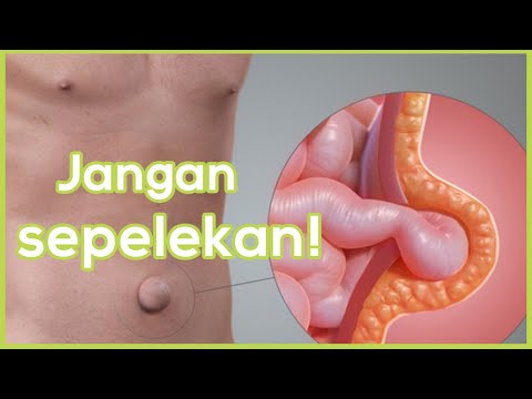 Video: Pembedahan Untuk Mengangkat Cakram Tulang Belakang Yang Hernia - Indikasi, Konsekuensi, Jenis Operasi