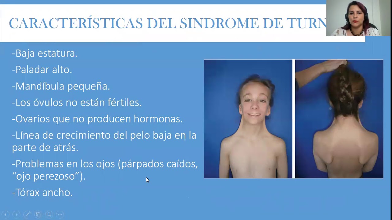 sindrome de turner - YouTube