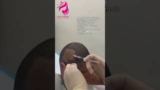 Alopecia areata occur's when the immune system attack hair follicles and mayus:7840050530-8077843257